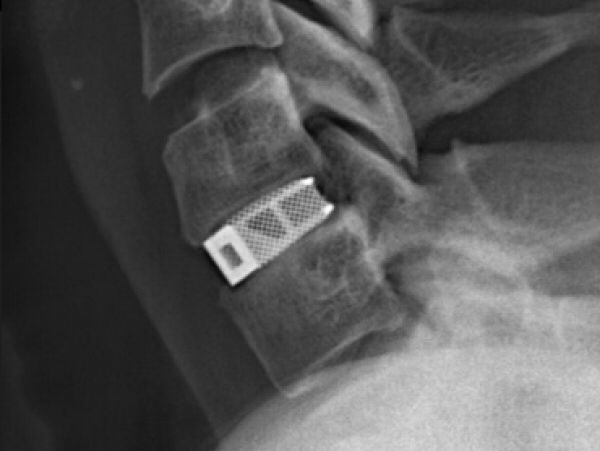 Titanium spinal implant